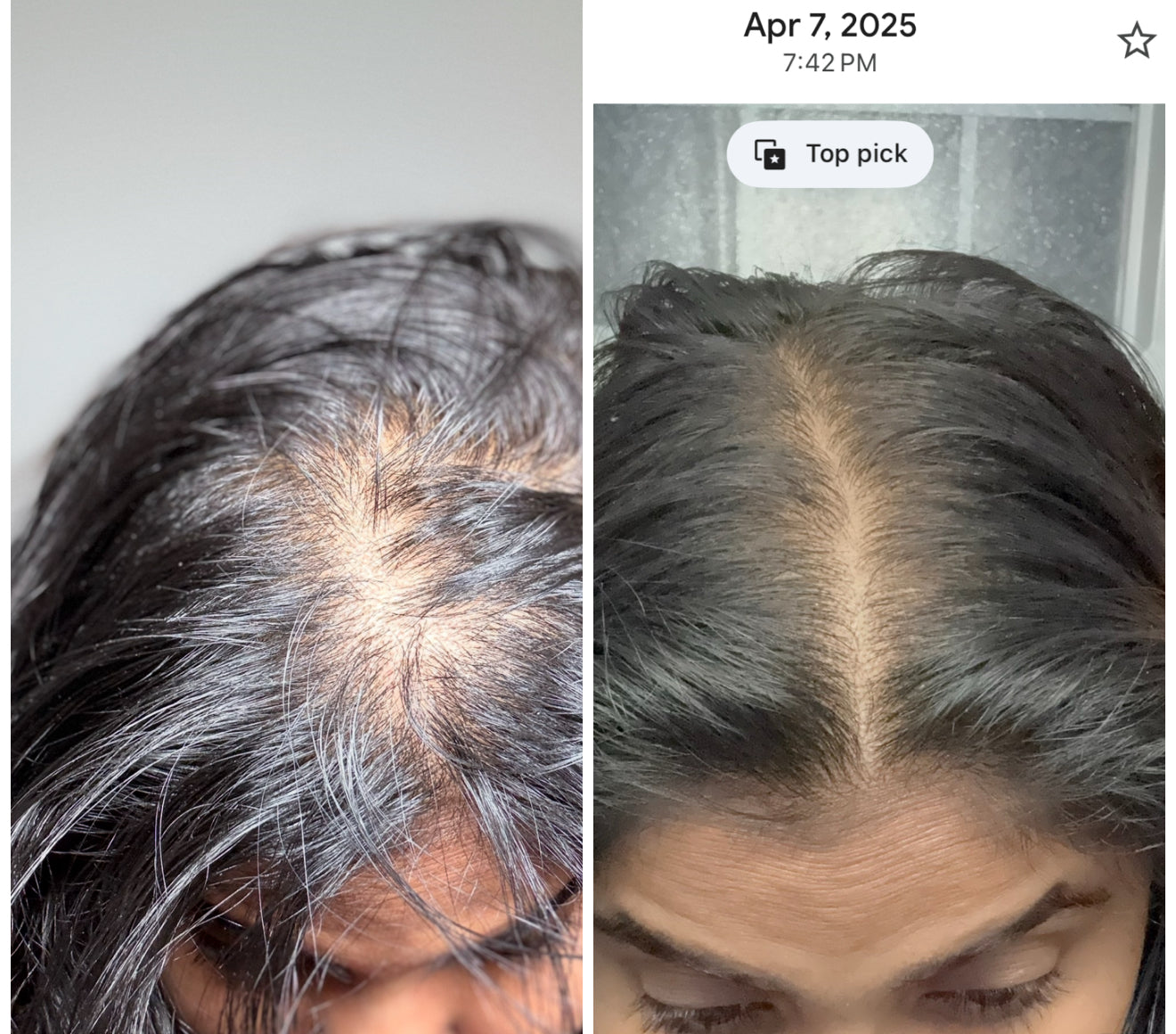 Hair loss Solution 